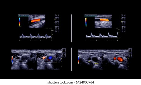 Ultrasound Doppler For Diagnosis   Deep Vein Thrombosis Disease Of Lower Extremity Or DVT.