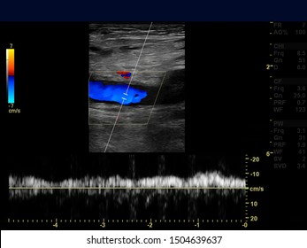 Ultrasound Doppler Of Femoral Vien For Finding  Deep Vein Thrombosis Or DVT.