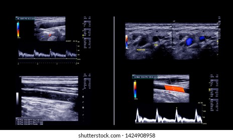 Ultrasound Doppler Finding Deep Vein Thrombosis Stock Photo 1424908958 ...