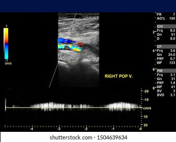 Ultrasound Doppler Of Popliteal Vien For Finding  Deep Vein Thrombosis Or DVT.