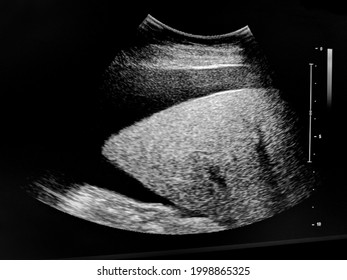 Hepatomegaly Images Stock Photos Vectors Shutterstock Hepatomegaly Images Stock Photos Vectors Shutterstock
