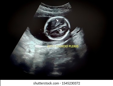 Ultrasound Of Fetal Choroid Plexus