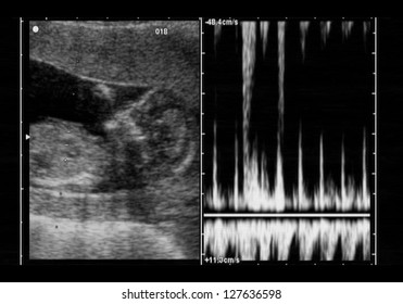 Ultrasound Fetus At 12 Weeks With Heart Beat Graph