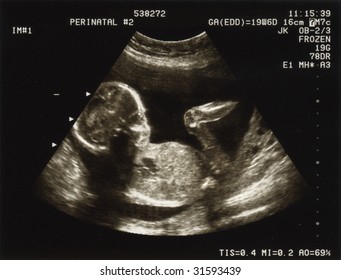 Ultrasound Of A Fetus At 20 Weeks