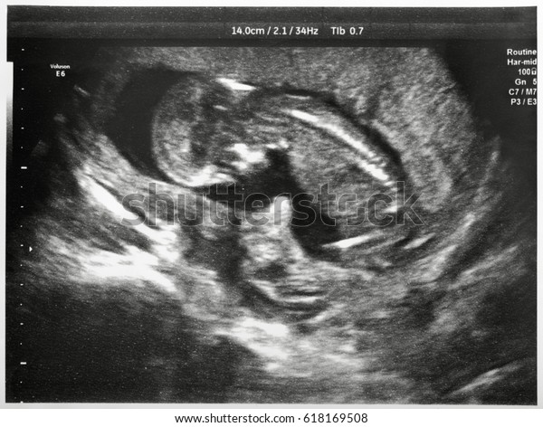 Ultrasound Fetus 9th Month Pregnancy Stock Photo (Edit Now) 618169508