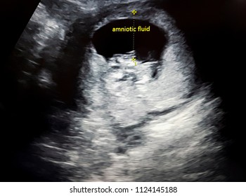 Ultrasound With Fetus And Amniotic Fluid