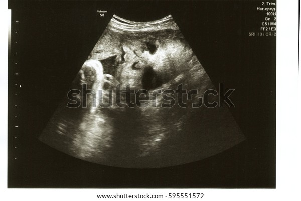 Echographie Du Foetus A 33 Semaines Photo De Stock Modifiable