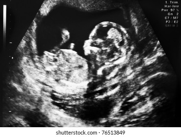 Ultrasound Of Fetus At Fourth Month