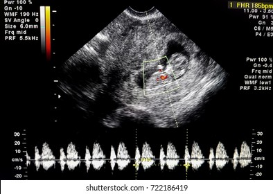 Ultrasound of Fetus - measuring heart rate