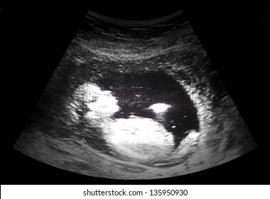 ultrasound film of thirteen week fetus
