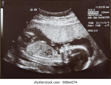 Ultrasound of a four month old baby fetus