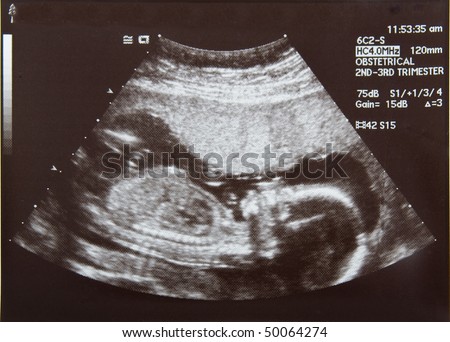 Ultrasound of a four month old baby fetus