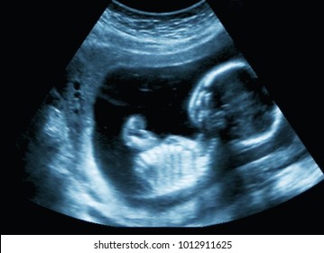 An ultrasound of a human fetus during the 16th week.