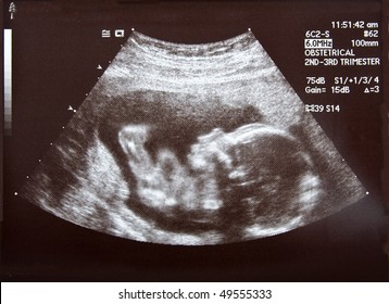 An ultrasound of a human fetus during the 17th week.