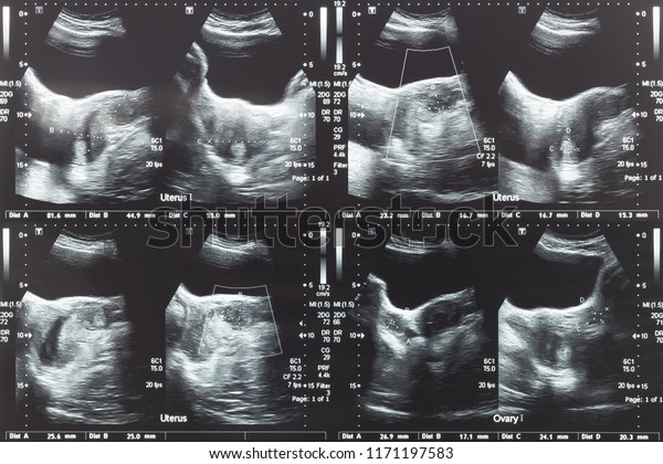 Ultrasound Image Lower Abdomen Ovary Uterus 库存照片 立即编辑 1171197583