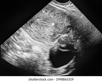 Ultrasound Image Of Ovarian Cyst. Gynecological Ultrasound, Ovarium Cysta