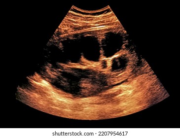 Ultrasound Image - Renal Cysts, Kidney Cysts