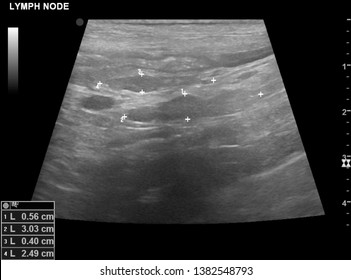 Ultrasound Image Showing Enlarged Lymph Nodes In A Dog With Lymphoma 