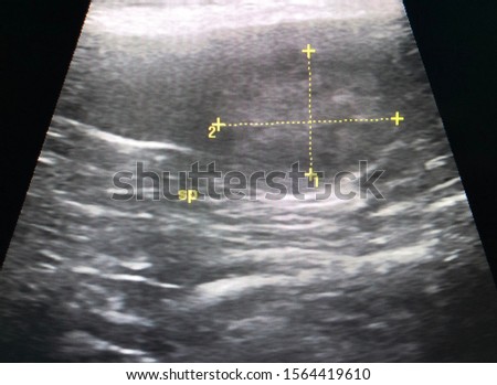 Ultrasound image showing inhomogeneous splenic mass of anemia and thrombocytopenia sick old dog may be splenic tumor, splenic granulomatous, splenic abscess, animal hospital, veterinary medicine