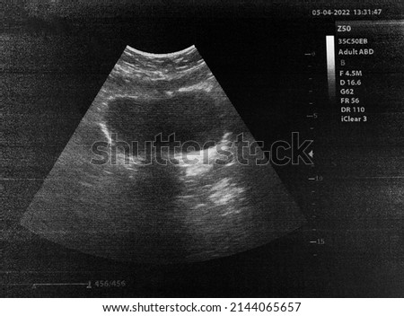 an ultrasound image of a tumor