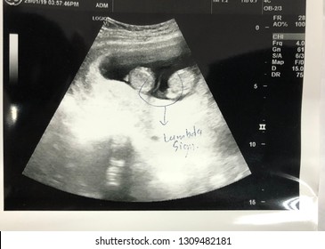 Pregnancy ultrasound images twin A Gallery