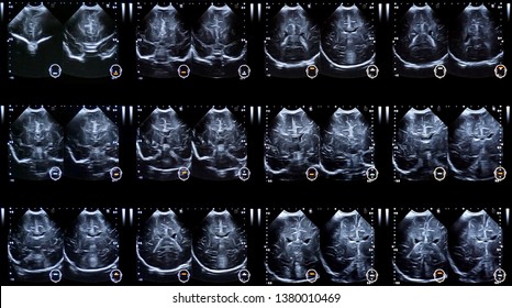  Ultrasound imaging used in medicine. child Brain.                              