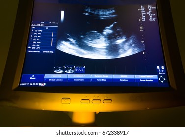 Ultrasound Monitor Screen Show Baby In Mother's Womb