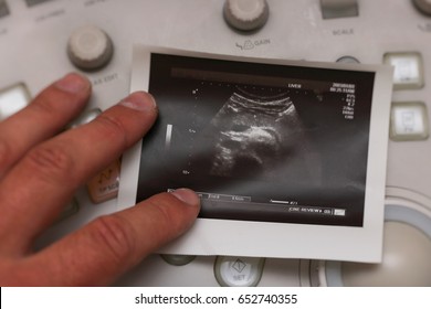 Ultrasound Photo - Small Pancreas Cancer