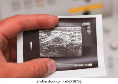 Ultrasound Photos In The Hand  - Metastatic Lymph Node In Breast Cancer