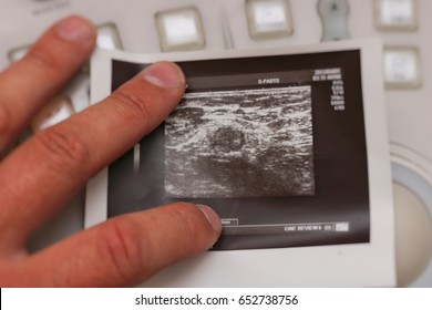 Ultrasound Photos - Metastatic Lymph Node In Breast Cancer