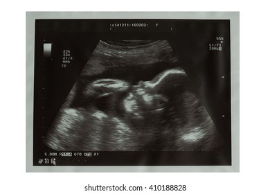 Free Free 177 Baby Ultrasound Svg SVG PNG EPS DXF File