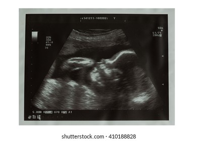 Free Free Baby Ultrasound Svg 265 SVG PNG EPS DXF File