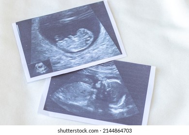 ultrasound pictures shows different gestational periods. sonogram of fetus, unborn yet baby, on white textile surface and blue heart means it's a baby boy. toy for teeth and white cotton bib. flat lay