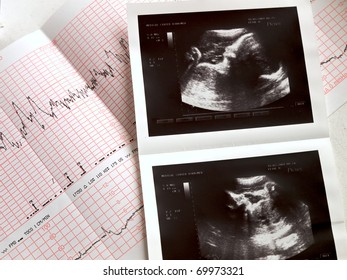 ultrasound portrait of the fetus and cardiogram results