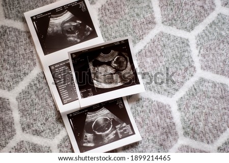 Ultrasound results in the second trimester of pregnancy. Photo of the fetus on a light geometric background. Expectation of the child. Infertility treatment. Artificial insemination. ECO.