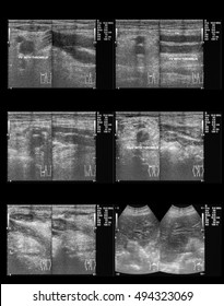 Ultrasound Of Right Leg, A 78 Year Old Female, Case Of Deep Venous Thrombosis (DVT)