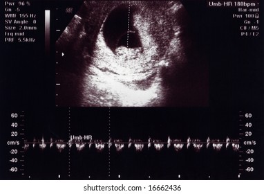 Ultrasound Scan 10 Weeks Heartbeat