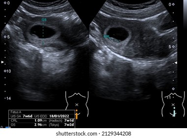 Ultrasound scan of a 7-week old foetus displaying the gestasional sac and a small fetus
 - Shutterstock ID 2129344208