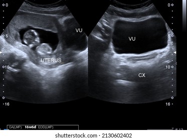 Ultrasound Scan Of A 7-week Old Foetus Displaying The Gestational Sac And Al Fetus
