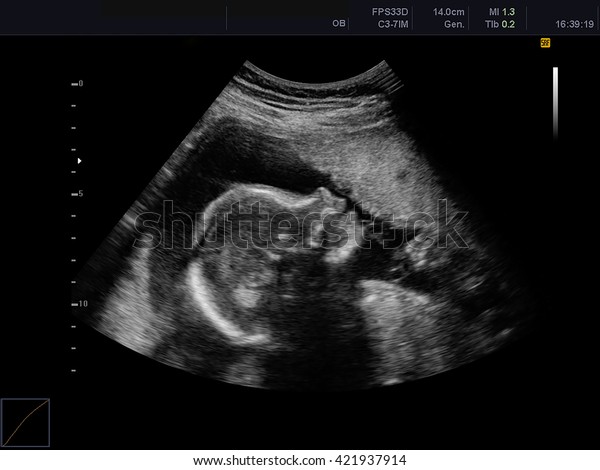 Ultrasound Scan Baby Stock Photo 421937914 | Shutterstock