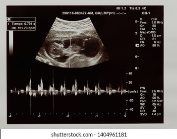 Ultrasound Scan Of Future Baby With Heart Beat Parameters 