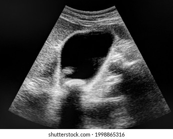 ultrasound scan of gallstones. gallbladder with stones - cholelithiasis. - Shutterstock ID 1998865316