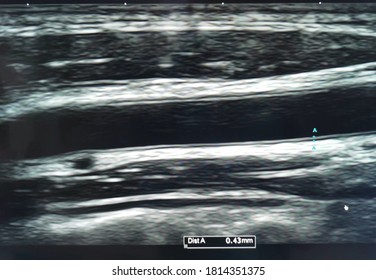 Ultrasound scan of normal carotid artey, showing normal intima-media thickness