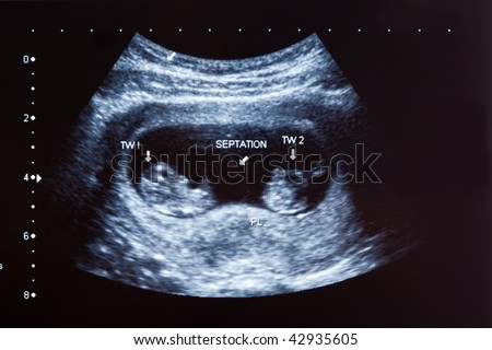 Ultrasound scan of ten months old twin boys
