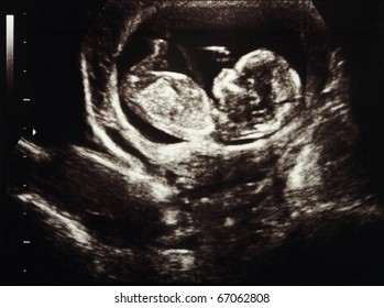 Ultrasound scans during pregnancy in the thirteenth week