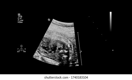 Ultrasound Screen Fetal Echocardiography Stock Photo 1740183104 ...