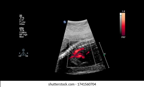 Ultrasound Screen With Fetal Echocardiography