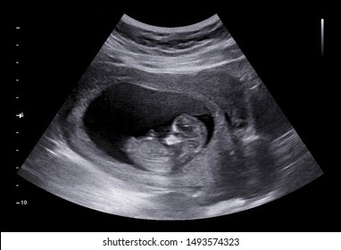 Ultrasound small baby at 12 weeks. 12 weeks pregnant ultrasound image show baby or fetus development and pregnancy health checking.