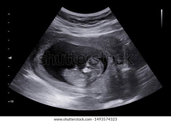 Ultrasound small baby at 12 weeks. 12 weeks\
pregnant ultrasound image show baby or fetus development and\
pregnancy health\
checking.