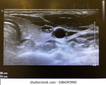 Ultrasound Thyroid Gland Showed Thryroid Cyst